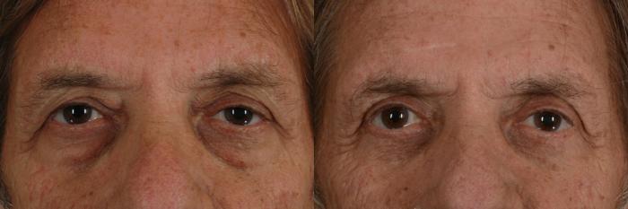 Before & After Eyelid Surgery (Blepharoplasty) Case 19 View #1 View in Tallahassee, FL
