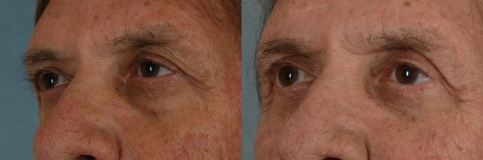 Before & After Eyelid Surgery (Blepharoplasty) Case 19 View #2 View in Tallahassee, FL