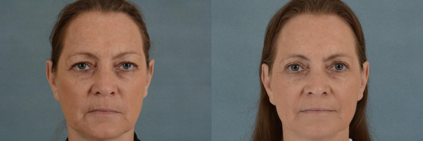 Before & After Eyelid Surgery (Blepharoplasty) Case 20 View #1 View in Tallahassee, FL