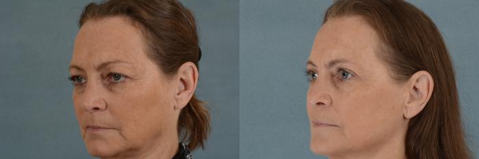 Before & After Eyelid Surgery (Blepharoplasty) Case 20 View #3 View in Tallahassee, FL