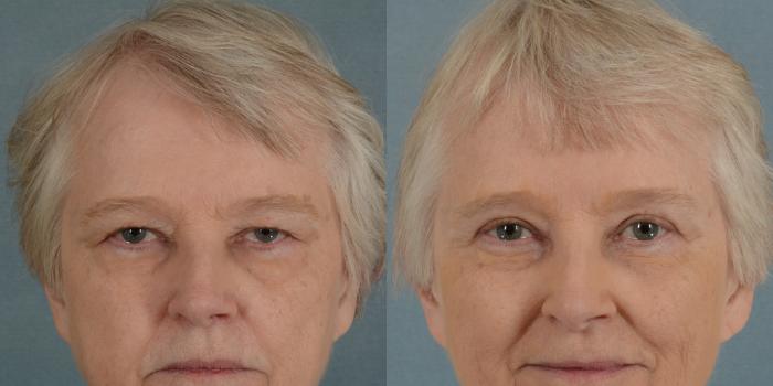Before & After Eyelid Surgery (Blepharoplasty) Case 21 View #1 View in Tallahassee, FL