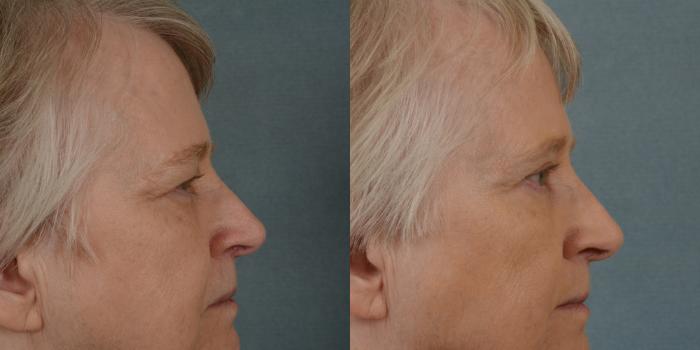 Before & After Eyelid Surgery (Blepharoplasty) Case 21 View #2 View in Tallahassee, FL