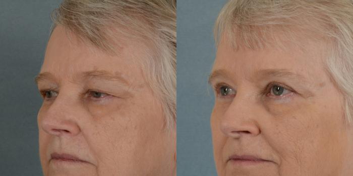 Before & After Eyelid Surgery (Blepharoplasty) Case 21 View #3 View in Tallahassee, FL