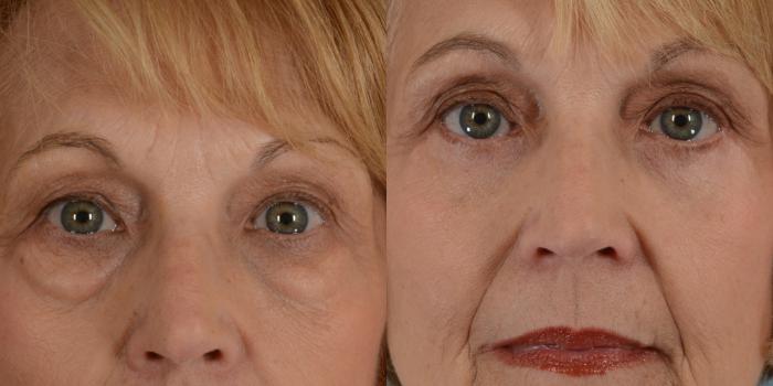 Before & After Eyelid Surgery (Blepharoplasty) Case 22 View #1 View in Tallahassee, FL