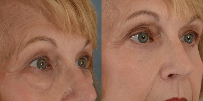 Before & After Eyelid Surgery (Blepharoplasty) Case 22 View #2 View in Tallahassee, FL