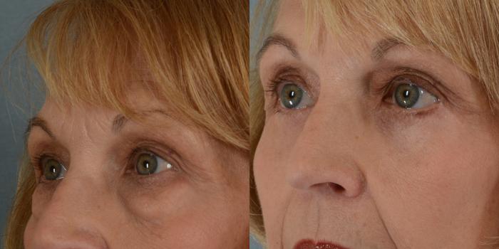Before & After Eyelid Surgery (Blepharoplasty) Case 22 View #3 View in Tallahassee, FL