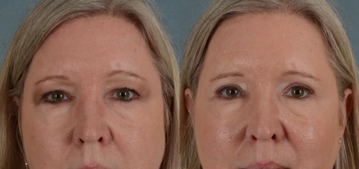 Before & After Eyelid Surgery (Blepharoplasty) Case 23 View #1 View in Tallahassee, FL