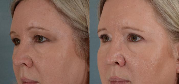 Before & After Eyelid Surgery (Blepharoplasty) Case 23 View #2 View in Tallahassee, FL