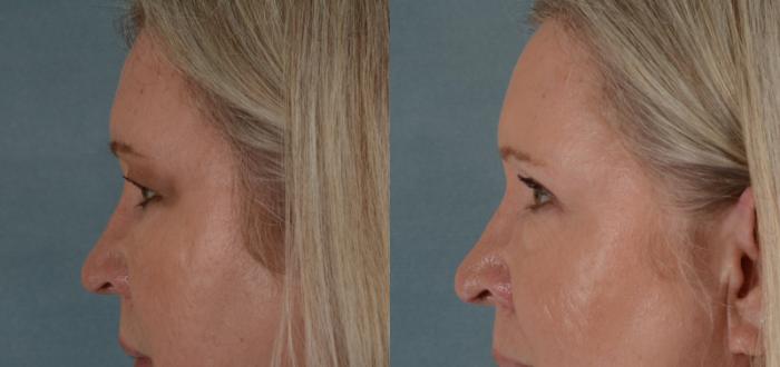 Before & After Eyelid Surgery (Blepharoplasty) Case 23 View #3 View in Tallahassee, FL