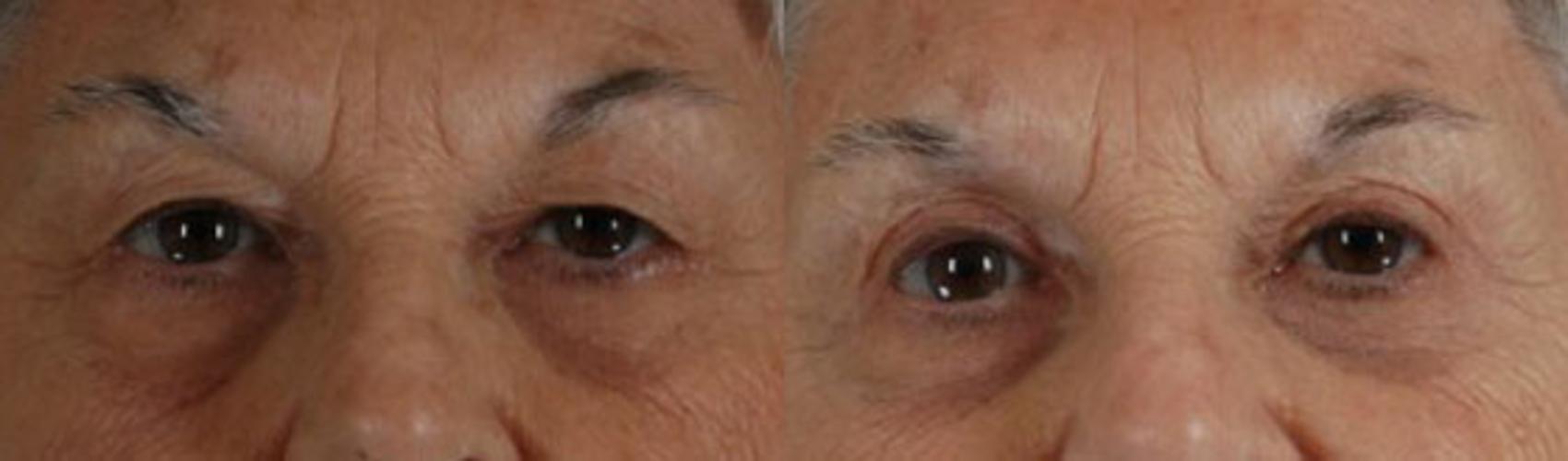 Before & After Eyelid Surgery (Blepharoplasty) Case 25 View #1 View in Tallahassee, FL