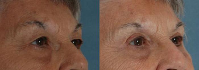Before & After Eyelid Surgery (Blepharoplasty) Case 25 View #2 View in Tallahassee, FL