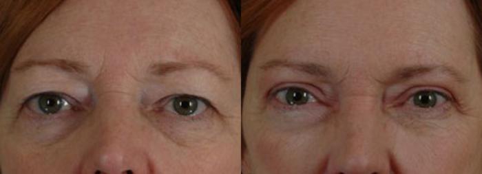 Before & After Eyelid Surgery (Blepharoplasty) Case 26 View #1 View in Tallahassee, FL