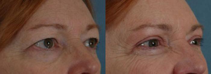 Before & After Eyelid Surgery (Blepharoplasty) Case 26 View #2 View in Tallahassee, FL