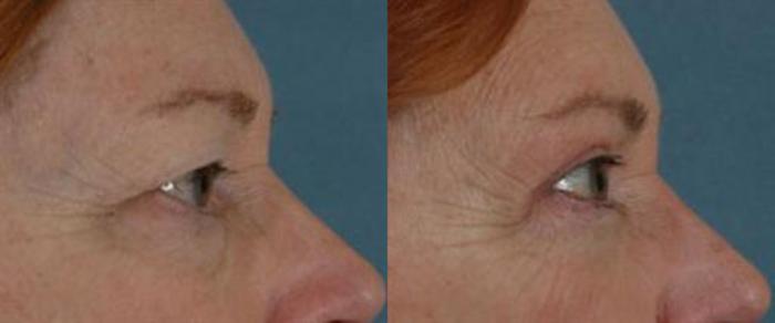 Before & After Eyelid Surgery (Blepharoplasty) Case 26 View #3 View in Tallahassee, FL