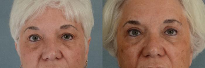 Before & After Eyelid Surgery (Blepharoplasty) Case 268 View #1 View in Tallahassee, FL