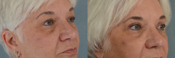 Before & After Eyelid Surgery (Blepharoplasty) Case 268 View #2 View in Tallahassee, FL