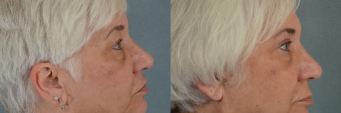 Before & After Eyelid Surgery (Blepharoplasty) Case 268 View #3 View in Tallahassee, FL