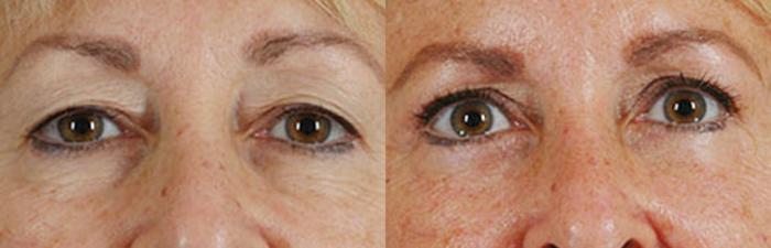 Before & After Eyelid Surgery (Blepharoplasty) Case 27 View #1 View in Tallahassee, FL