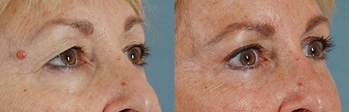 Before & After Eyelid Surgery (Blepharoplasty) Case 27 View #2 View in Tallahassee, FL