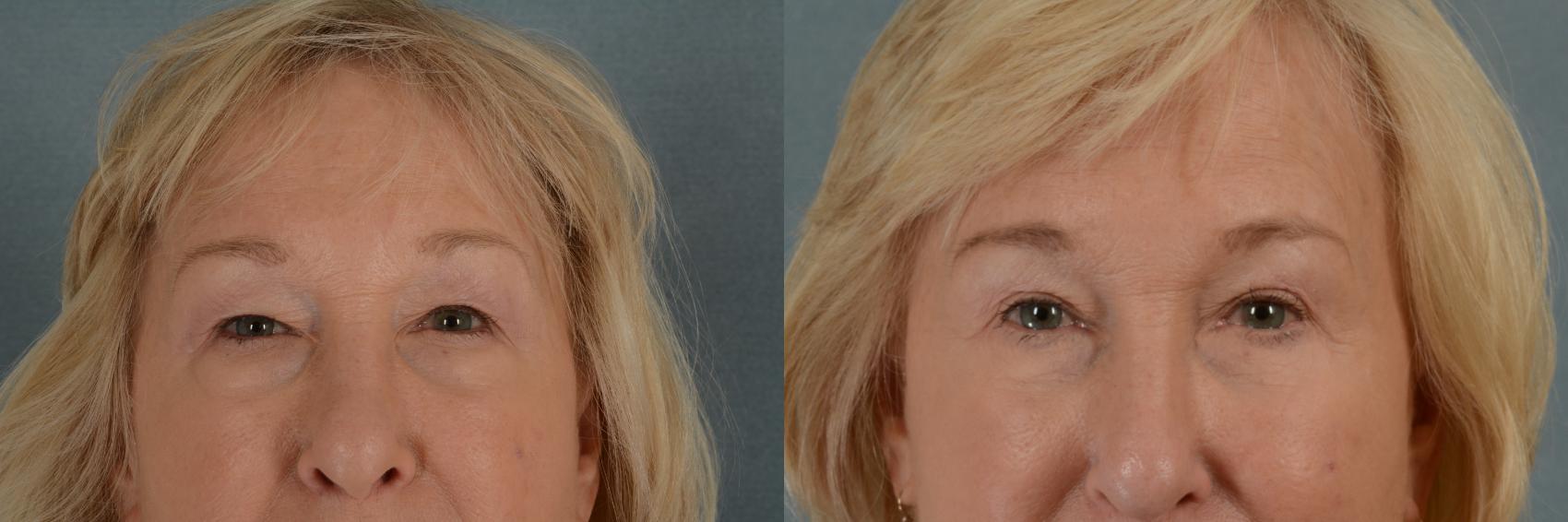 Before & After Eyelid Surgery (Blepharoplasty) Case 276 View #1 View in Tallahassee, FL