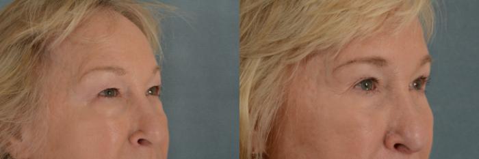 Before & After Eyelid Surgery (Blepharoplasty) Case 276 View #2 View in Tallahassee, FL