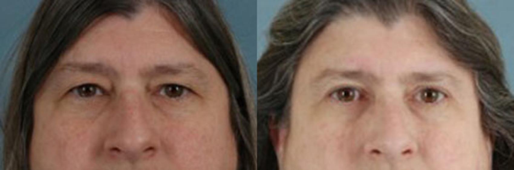 Before & After Eyelid Surgery (Blepharoplasty) Case 28 View #1 View in Tallahassee, FL