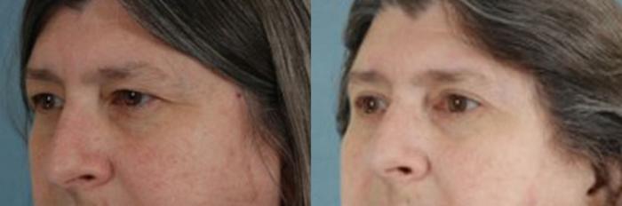 Before & After Eyelid Surgery (Blepharoplasty) Case 28 View #2 View in Tallahassee, FL