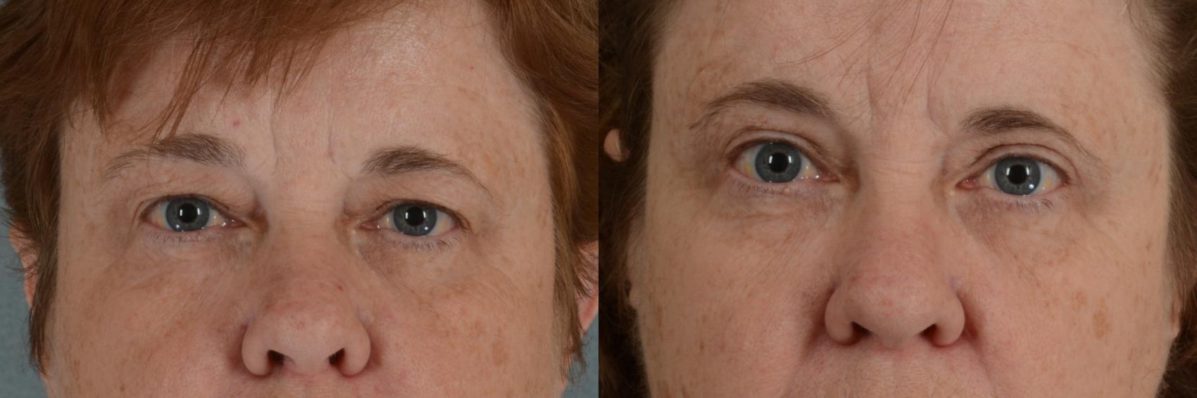 Before & After Eyelid Surgery (Blepharoplasty) Case 284 View #1 View in Tallahassee, FL