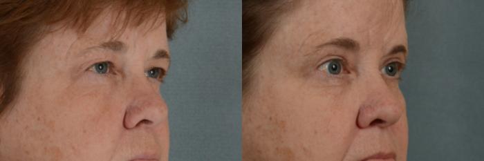 Before & After Eyelid Surgery (Blepharoplasty) Case 284 View #2 View in Tallahassee, FL
