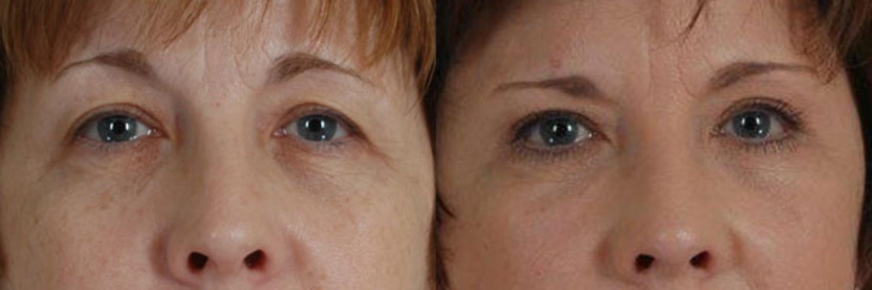 Before & After Eyelid Surgery (Blepharoplasty) Case 29 View #1 View in Tallahassee, FL