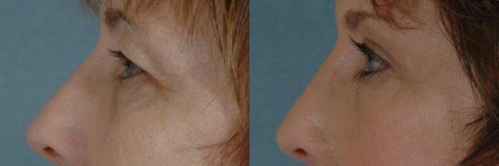 Before & After Eyelid Surgery (Blepharoplasty) Case 29 View #2 View in Tallahassee, FL
