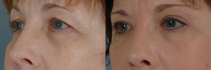 Before & After Eyelid Surgery (Blepharoplasty) Case 29 View #3 View in Tallahassee, FL