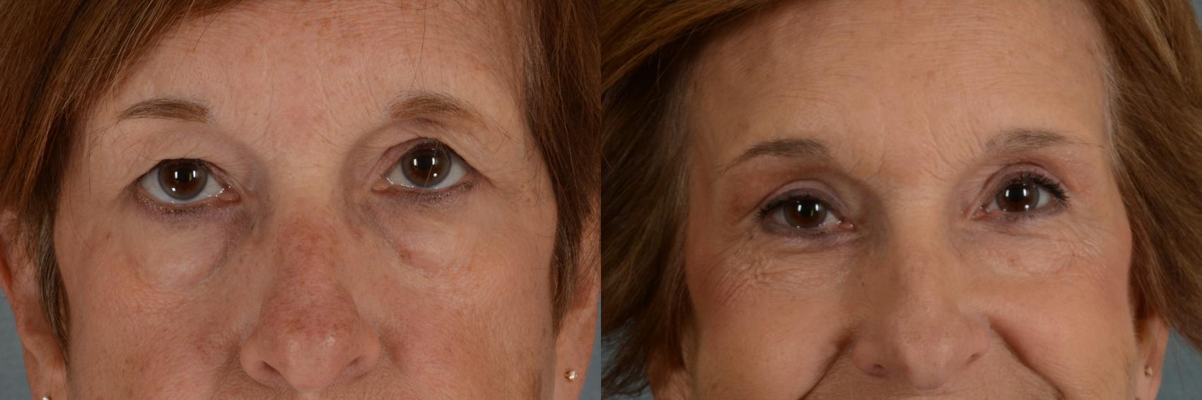 Before & After Eyelid Surgery (Blepharoplasty) Case 291 View #1 View in Tallahassee, FL