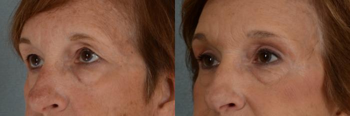 Before & After Eyelid Surgery (Blepharoplasty) Case 291 View #2 View in Tallahassee, FL