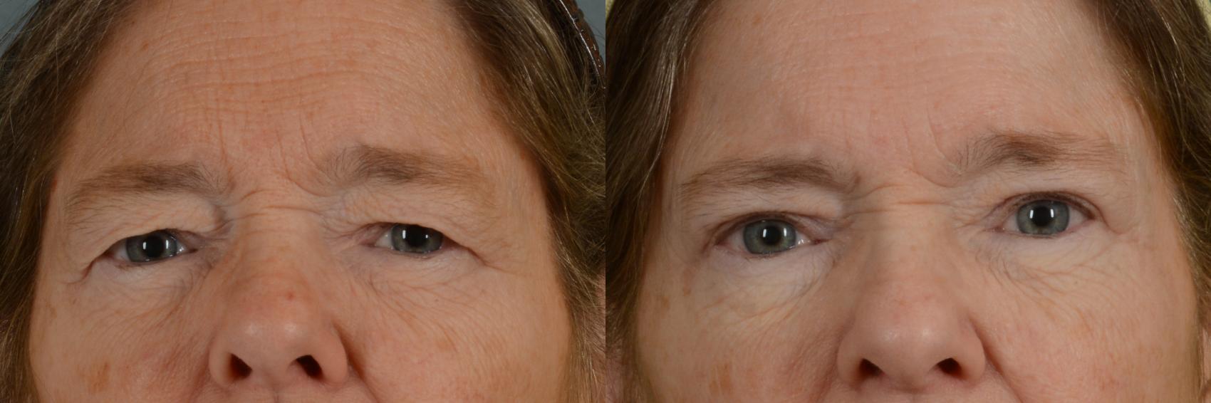 Before & After Eyelid Surgery (Blepharoplasty) Case 292 View #1 View in Tallahassee, FL