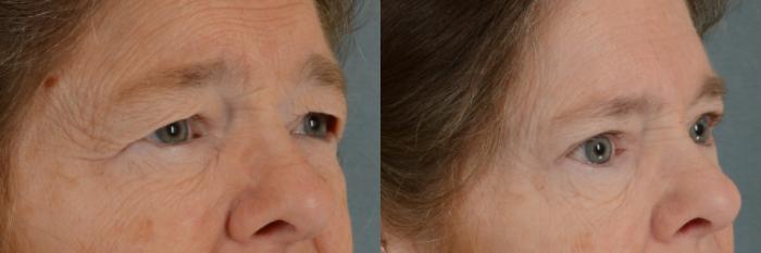 Before & After Eyelid Surgery (Blepharoplasty) Case 292 View #2 View in Tallahassee, FL