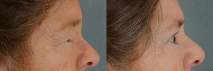 Before & After Eyelid Surgery (Blepharoplasty) Case 292 View #3 View in Tallahassee, FL