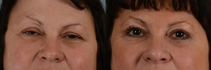 Before & After Eyelid Surgery (Blepharoplasty) Case 295 View #1 View in Tallahassee, FL