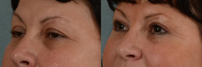 Before & After Eyelid Surgery (Blepharoplasty) Case 295 View #2 View in Tallahassee, FL