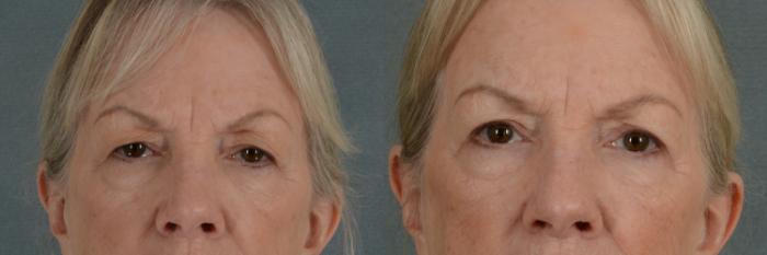 Before & After Eyelid Surgery (Blepharoplasty) Case 297 View #1 View in Tallahassee, FL