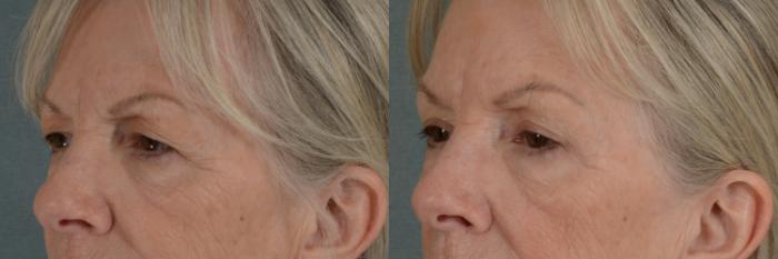 Before & After Eyelid Surgery (Blepharoplasty) Case 297 View #2 View in Tallahassee, FL