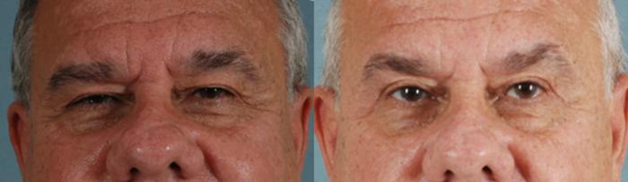 Before & After Eyelid Surgery (Blepharoplasty) Case 30 View #1 View in Tallahassee, FL