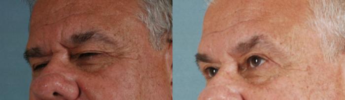 Before & After Eyelid Surgery (Blepharoplasty) Case 30 View #2 View in Tallahassee, FL