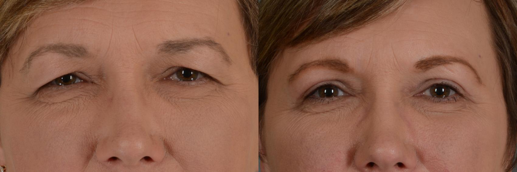 Before & After Eyelid Surgery (Blepharoplasty) Case 309 View #1 View in Tallahassee, FL