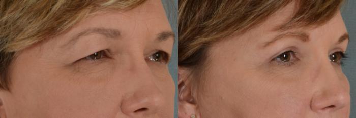 Before & After Eyelid Surgery (Blepharoplasty) Case 309 View #2 View in Tallahassee, FL