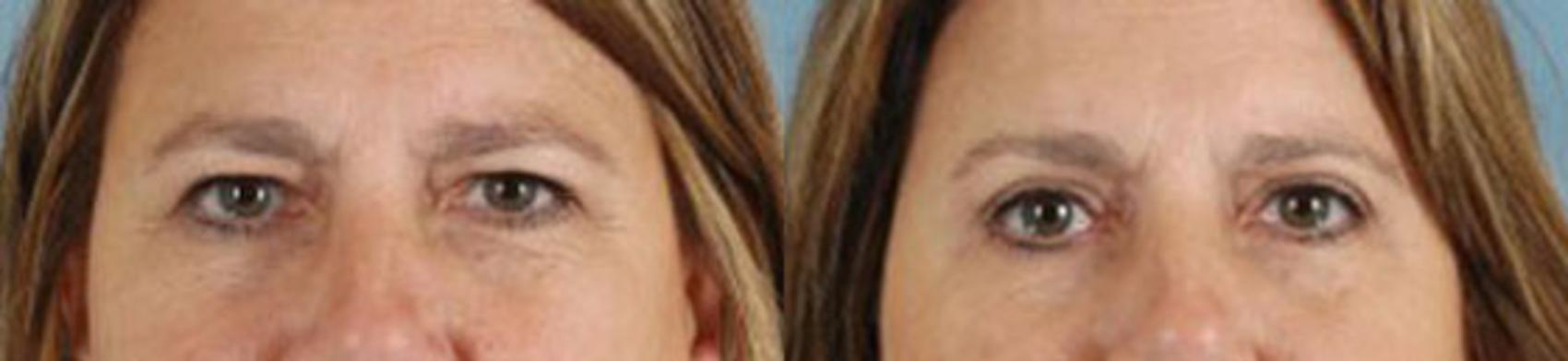 Before & After Eyelid Surgery (Blepharoplasty) Case 31 View #1 View in Tallahassee, FL