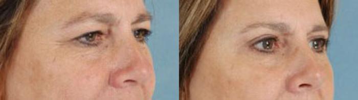 Before & After Eyelid Surgery (Blepharoplasty) Case 31 View #2 View in Tallahassee, FL