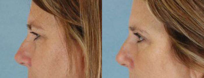 Before & After Eyelid Surgery (Blepharoplasty) Case 31 View #3 View in Tallahassee, FL