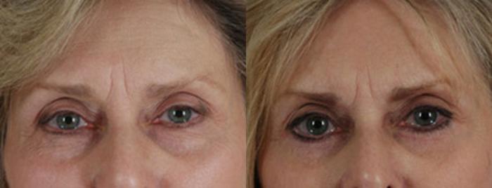 Before & After Eyelid Surgery (Blepharoplasty) Case 32 View #1 View in Tallahassee, FL