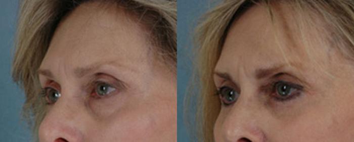 Before & After Eyelid Surgery (Blepharoplasty) Case 32 View #2 View in Tallahassee, FL